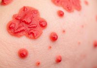 Wyprysk alergiczny – przyczyny, objawy i skuteczne leczenie