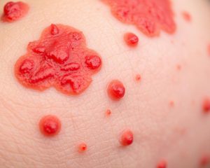 Wyprysk alergiczny – przyczyny, objawy i skuteczne leczenie