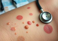 Zmiany skórne w chorobach reumatycznych – objawy, diagnostyka i terapia